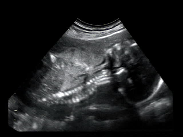 Side Profile Of A Baby Moving During A Ultrasound Stock Footage Video 