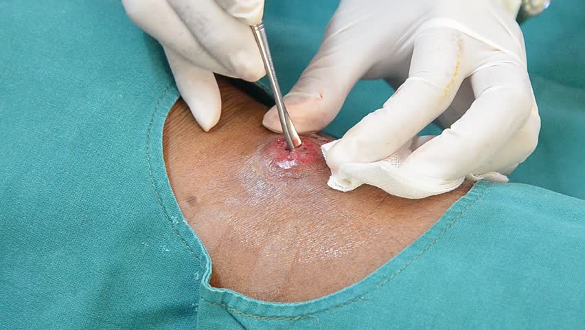 Header of abscess