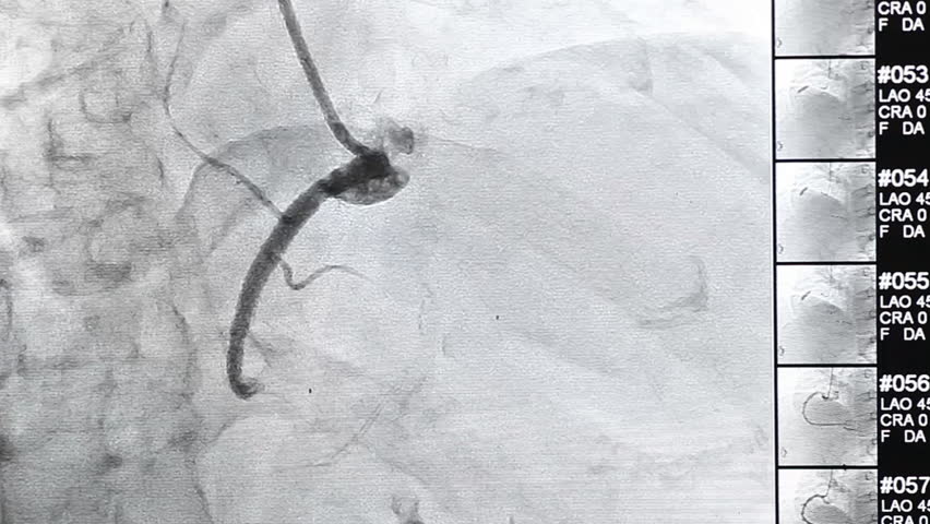 Header of ablation