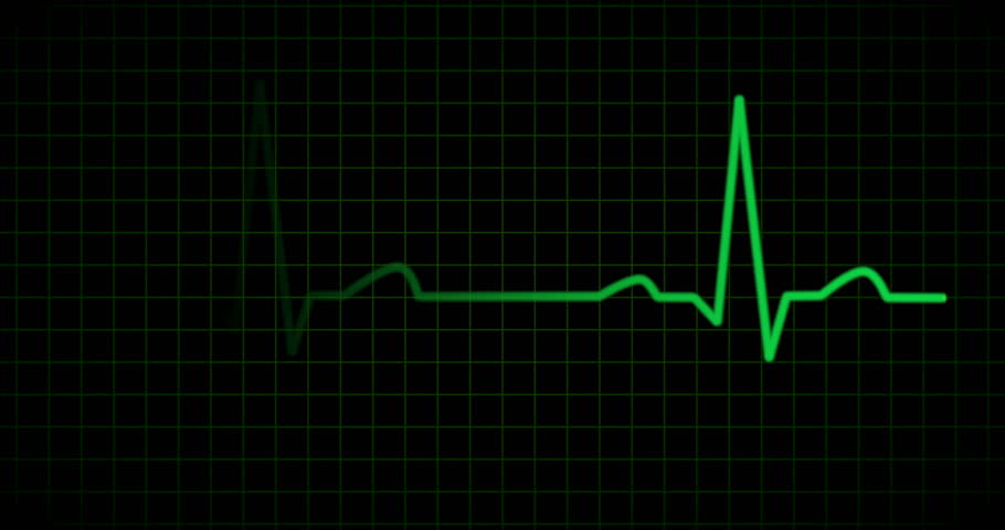 HD ECG / EKG-curve. A Typical ECG Tracing Of A Normal Heartbeat (or ...