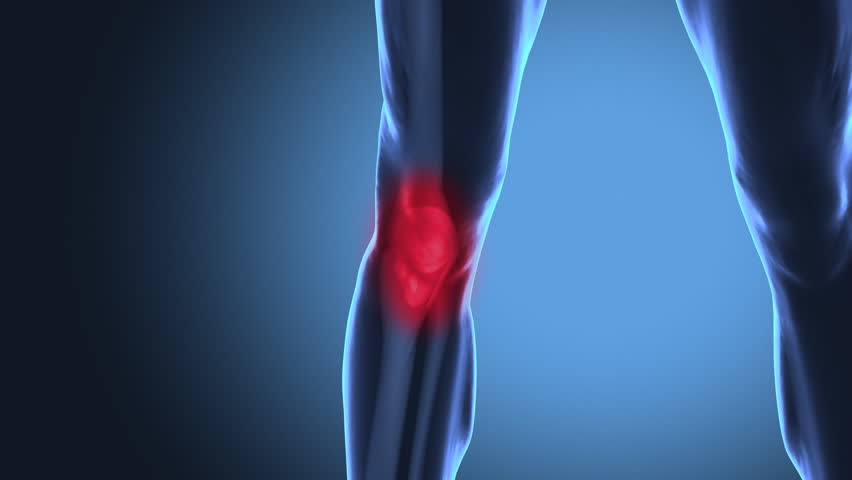 Knee Pain Animation. Three High Quality Animations Of Knee Pain. Stock ...